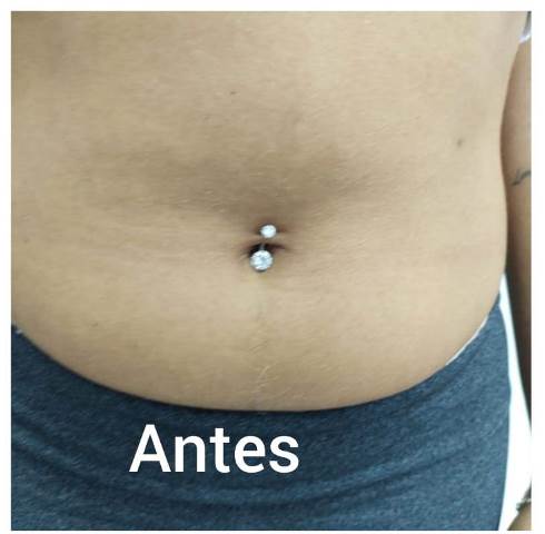 3-antes-e-depois-criolipolise-antes-3